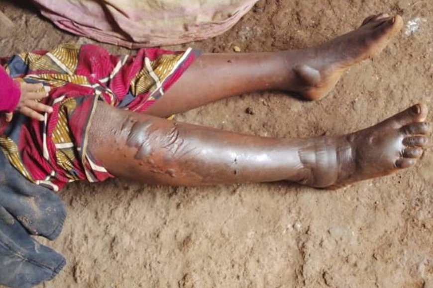 Rusizi: Umugabo afunzwe akurikiranyweho gutwika umugore we akoresheje amavuta yo guteka