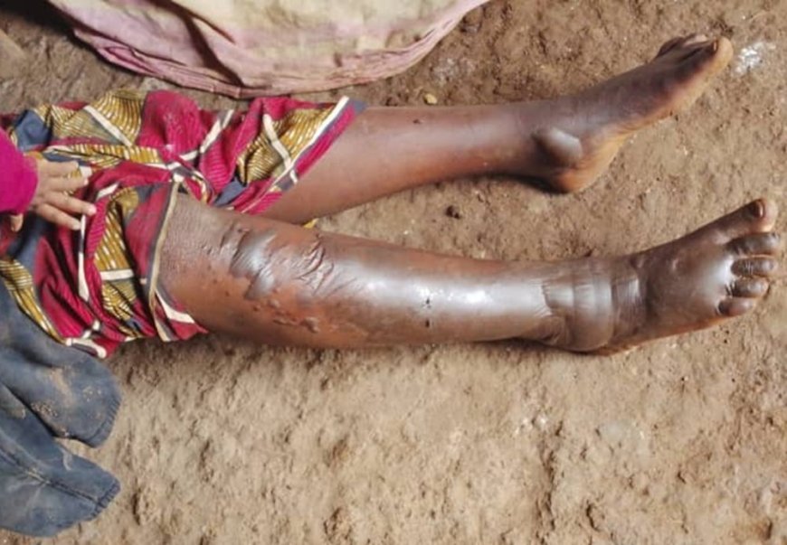 Rusizi: Umugabo afunzwe akurikiranyweho gutwika umugore we akoresheje amavuta yo guteka